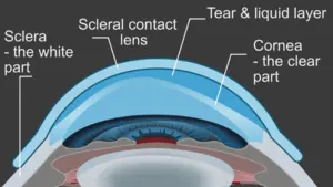 Scleral lens fitting for keratoconus in cambridge, on